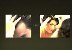 CALVÍCIE – ALOPECIA ANDROGENÉTICA