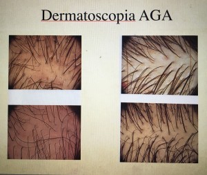 texto-2-alopecia-feminina-300x253.jpg. AGA